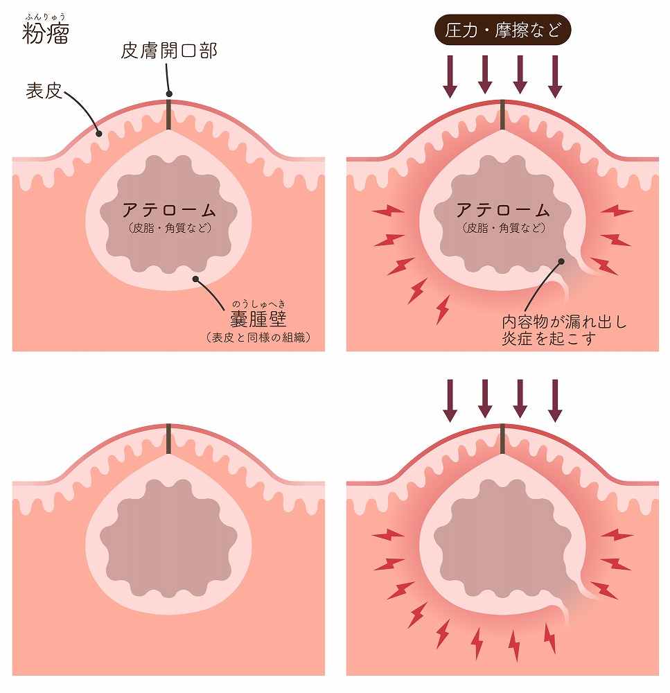 粉瘤（アテローム）とは