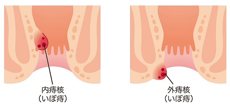 いぼ痔（内痔核・外痔核）