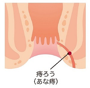 痔ろう